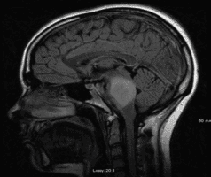 Diffuse brainstem glioma in an adolescent woman