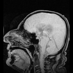 File:NPH MRI 272 GILD.gif
